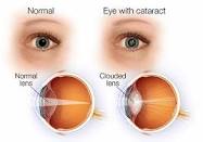 Longmont Eye Doctors Cataract Infographic
