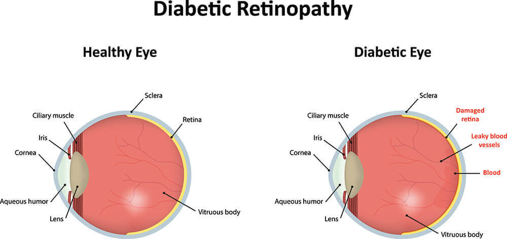 Diabetic Retinopathy: Longmont Eye Care Center
