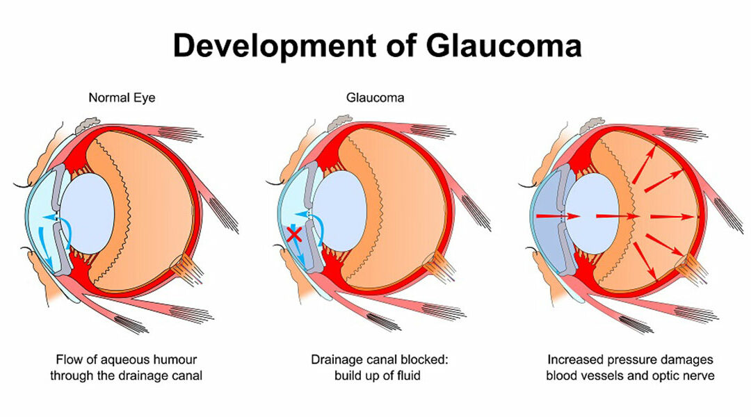 January Is Glaucoma Awareness Month