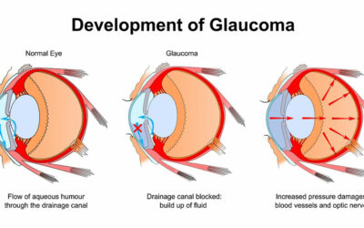 January Is Glaucoma Awareness Month