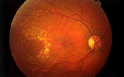 February: Age-Related Macular Degeneration Awareness Month
